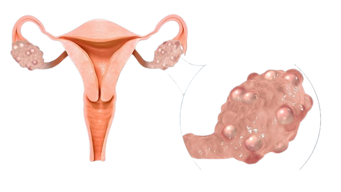 Polycystic Ovary Syndrome (PCOS): Symptoms & Treatment